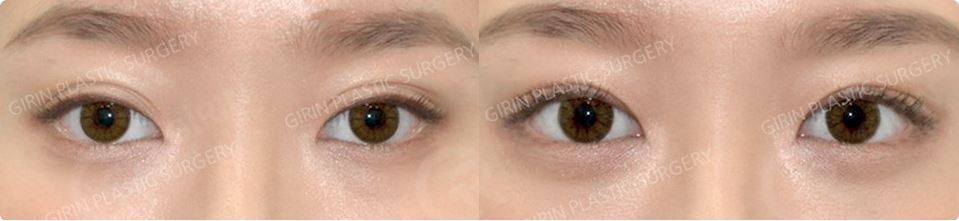 쌍수가격? 의미 없는 이유 관련 이미지 2