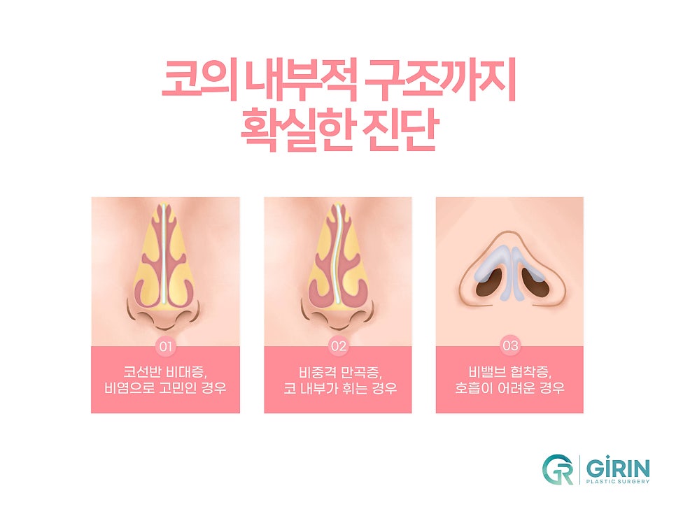 서울코재수술 마지막으로 살펴볼것 관련 이미지 9