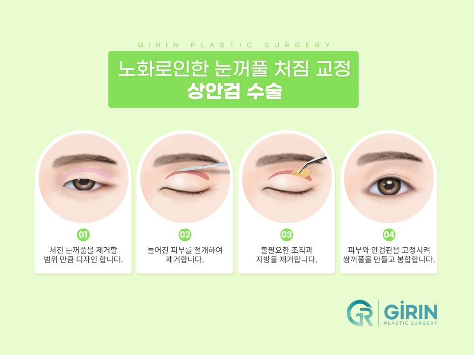 상안검수술잘하는곳 알아본다면 관련 이미지 7