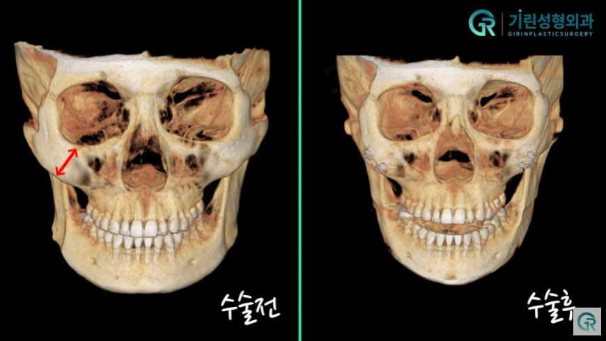 [기린성형외과의원] "카리나가 되고싶어요"_안면윤곽 수술일지 관련 이미지 6