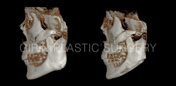 광대재수술+브이라인 전후 관련 이미지 3