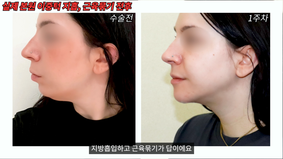 [기린성형외과] 윤곽수술후 살처짐 회생불가? 관련 이미지 9