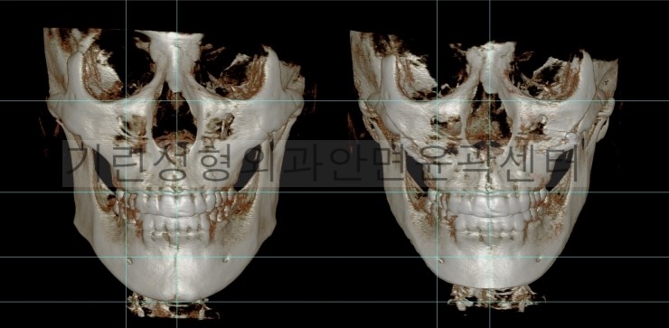 긴곡선 앞턱길이줄임+광대고정 관련 이미지 3