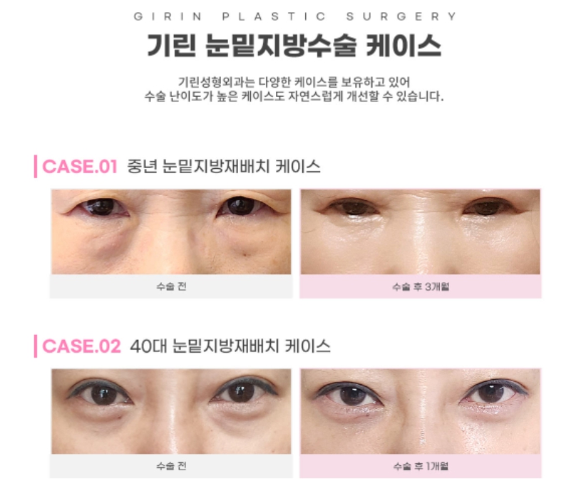 눈밑지방제거수술 하안검 선택의 폭이 넓어졌어요! 관련 이미지 6