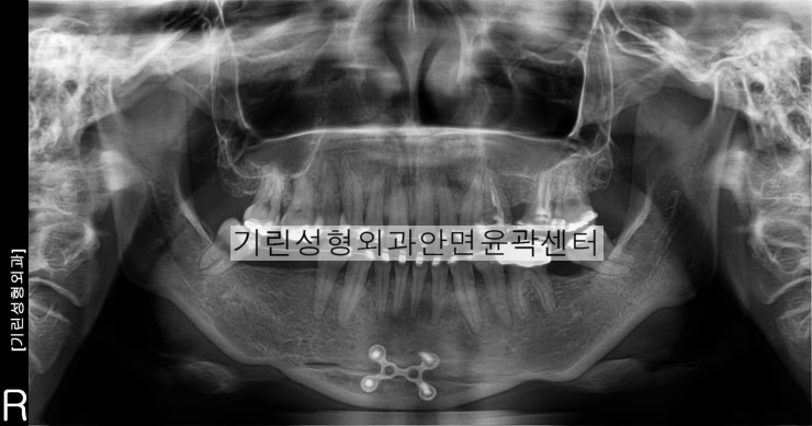 윤곽부작용사례-이차각 관련 이미지 1