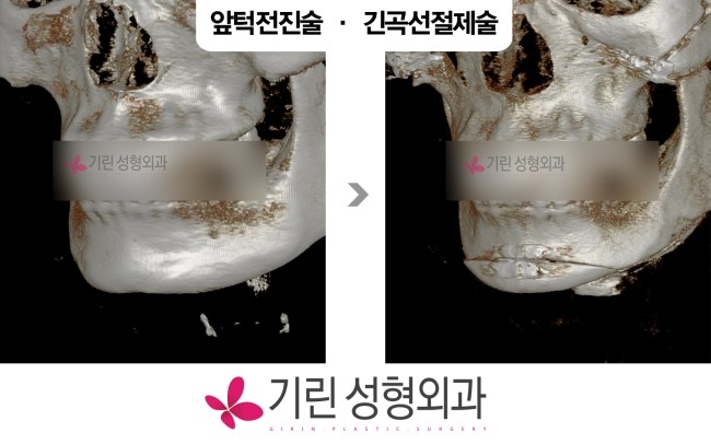 브이라인수술 : 앞턱전진술의 병행 관련 이미지 2