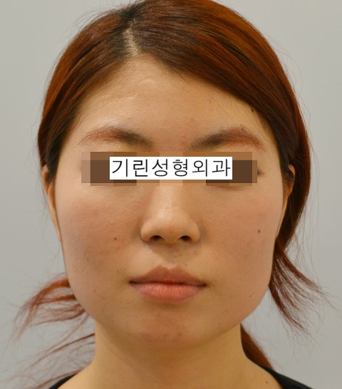최소박리로 진행되는 옆광대뼈축소술 관련 이미지 1