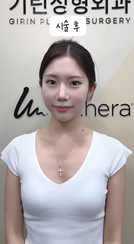 기린성형외과 인중리프팅 + 귀필러 관련 이미지 5