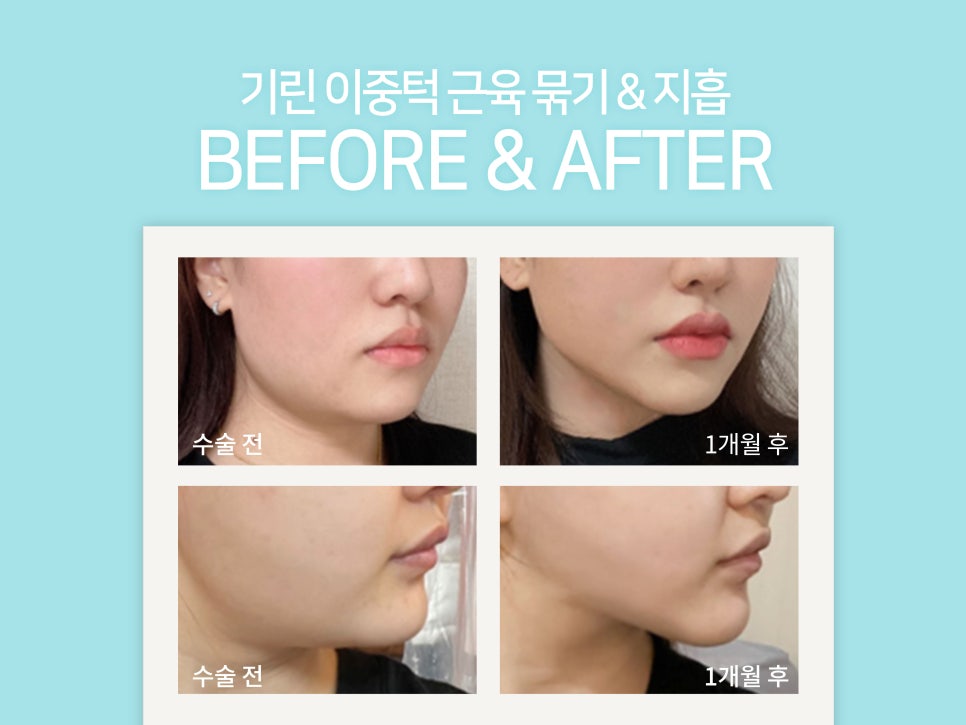 이중턱지방흡입 고려하고 있다면 관련 이미지 4