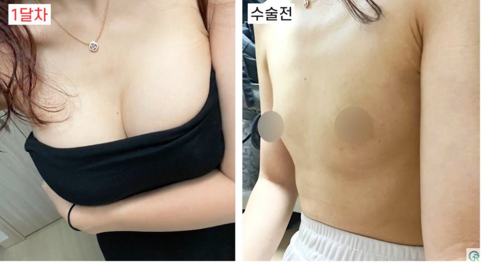 [기린성형외과의원] 자연스럽고 만족스러운 결과_마른체형의 가슴성형 수술일지 관련 이미지 10