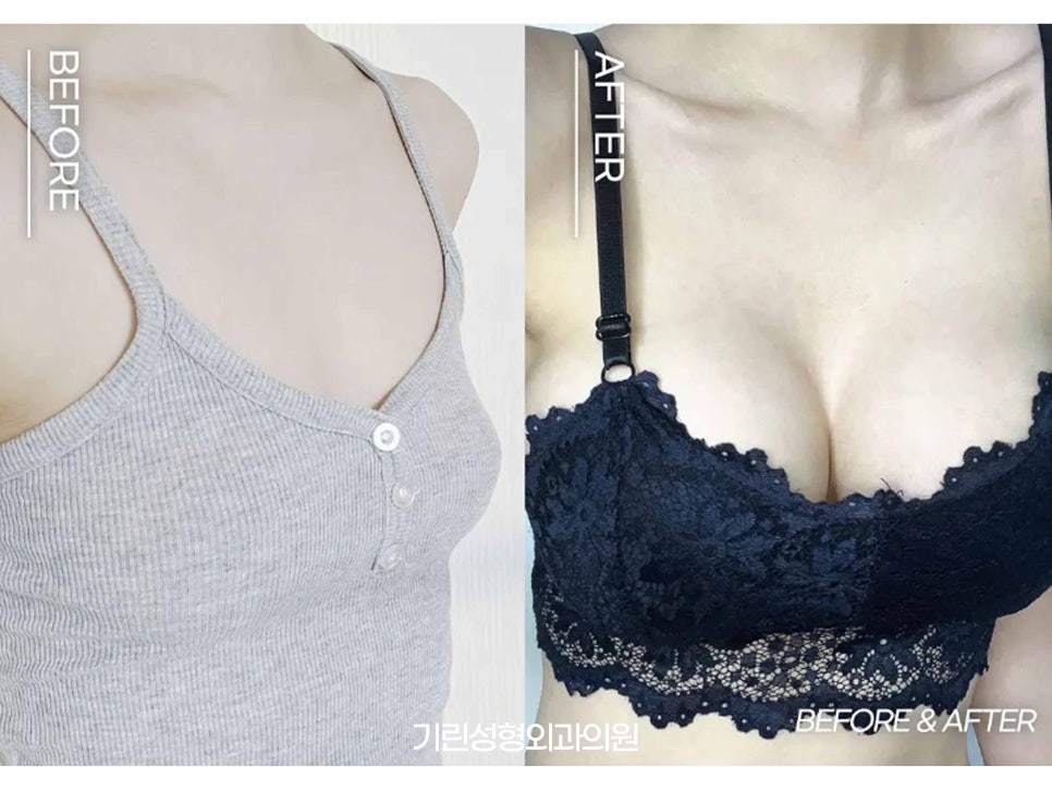 멘토가슴성형 다른 점이 무엇일까? 관련 이미지 2