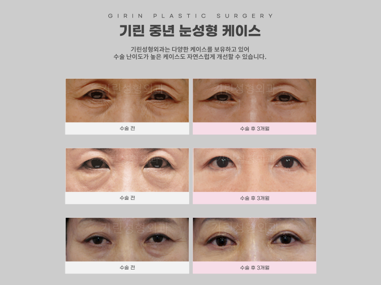 상하안검수술 인상을 바꾸기 위해 관련 이미지 15