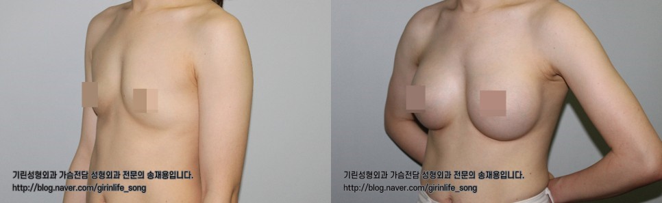 [가슴확대성형] 75A에서 75C로, 모티바 보형물을 이용한 가슴 확대 수술 케이스 관련 이미지 15