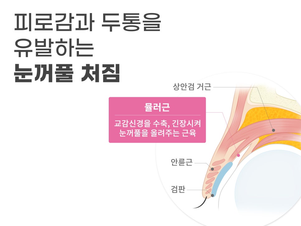 중년눈수술 어려지는 방법 중 하나? 관련 이미지 7