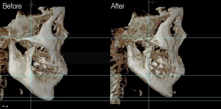 긴곡선절골로 앞턱길이를 함께 줄인 경우 관련 이미지 5
