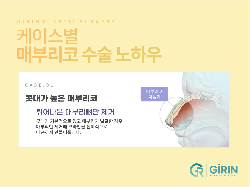 여자코성형 원하는 라인 고려하여 관련 이미지 7