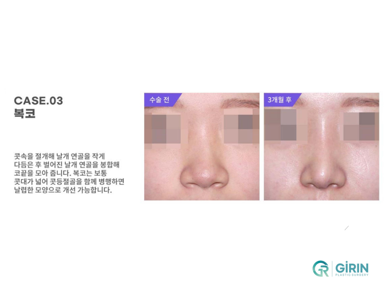 무보형물 코성형 안전하게 잘하는 곳 관련 이미지 9