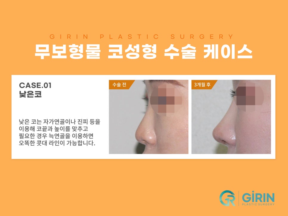 무보형물 코수술 자연스러운 코라인 관련 이미지 5