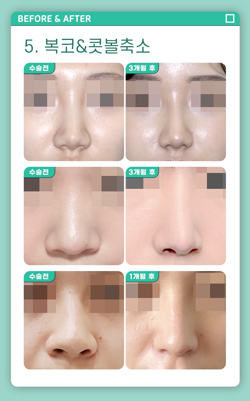 코성형수술비용 확실한 기준으로 정확하게 관련 이미지 5