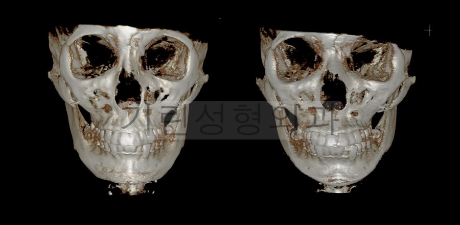 [브이라인재수술사례] 이차각제거 & 광대재수술이 필요없는 이유 관련 이미지 1