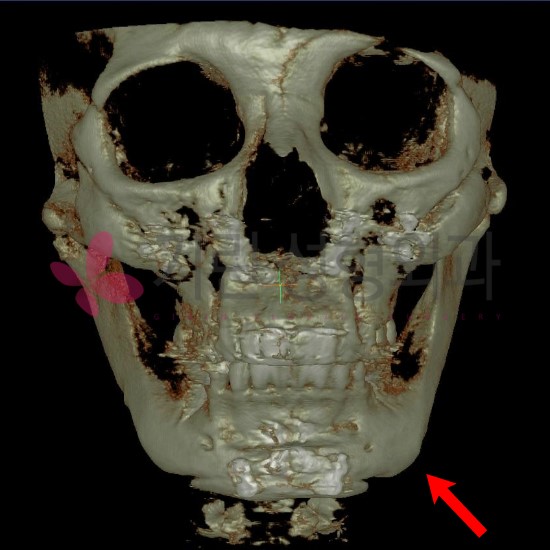 앞턱수술후 재수술사례(티절골부작용) 관련 이미지 1