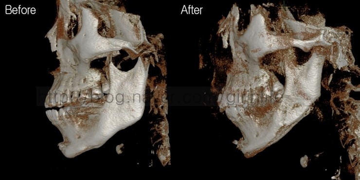 사각+앞턱을 했지만 효과가 떨어지는 경우 재수술사례 관련 이미지 2