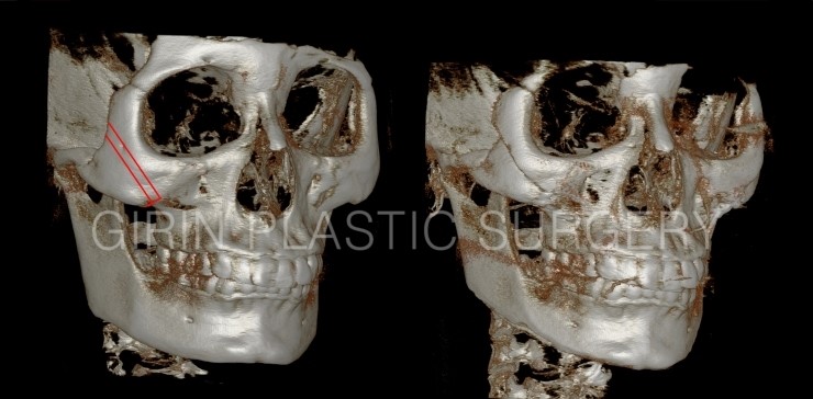 광대축소 불유합과 L절골에 대해 관련 이미지 1