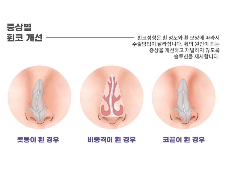 강남기능코성형 원인과 필요성 생각하여 관련 이미지 2