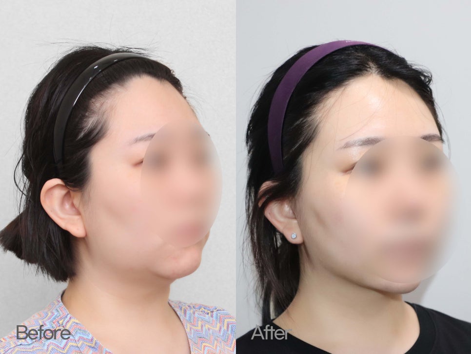 이중턱성형 차이가 궁금하다면 관련 이미지 6