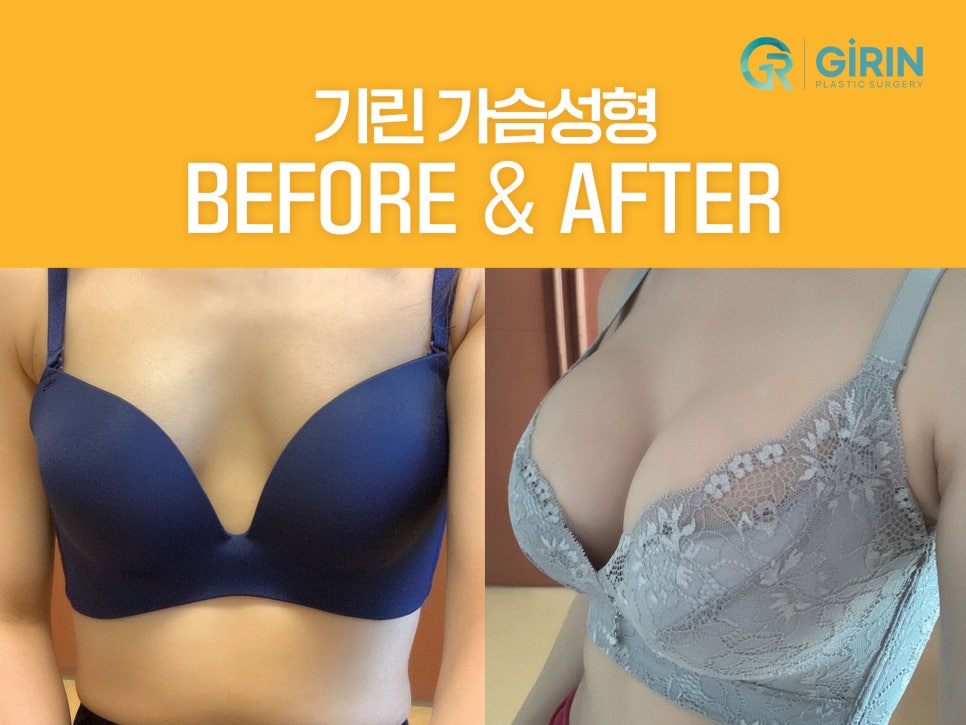 모티바가슴성형후기 세심하게 살펴보며 관련 이미지 13