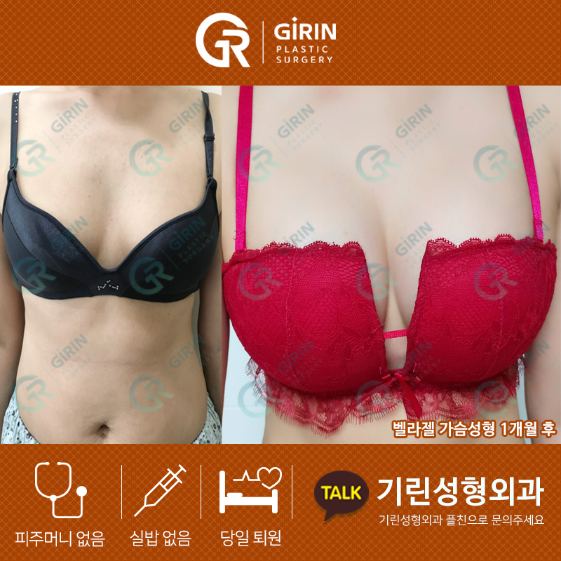 처진 가슴도 한방에! 기린 성형외과 송재용 원장 가슴 수술 후기 관련 이미지 4