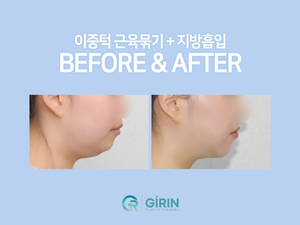 이중턱지방흡입 하나로 어렵다면? 관련 이미지 1