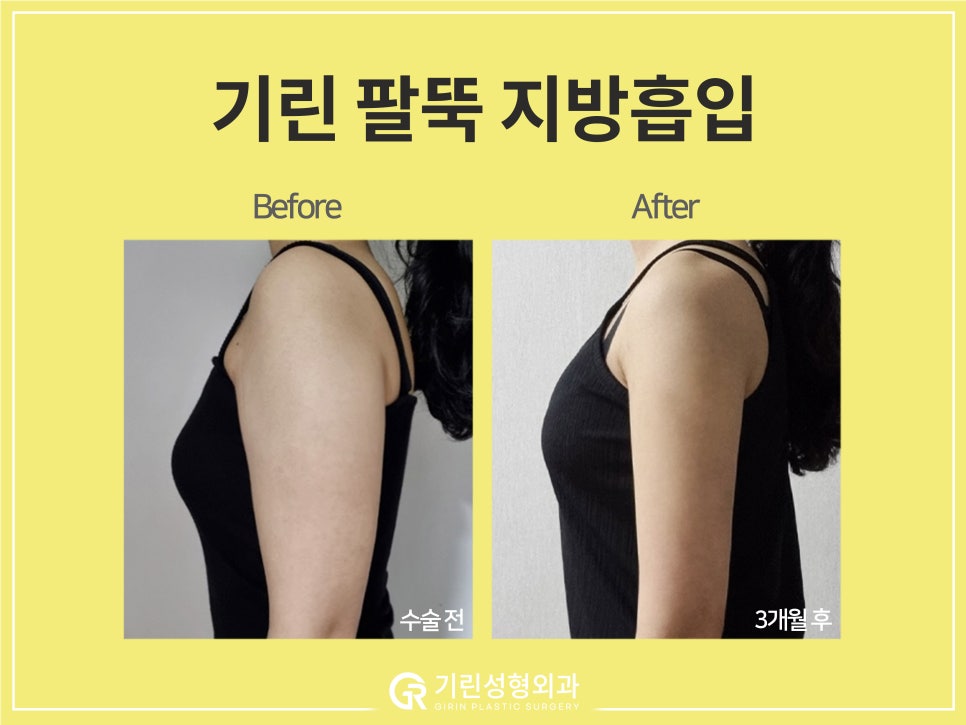 [기린 성형외과] 예쁜 라인 찾는 체형별 팔뚝지방흡입 관련 이미지 10