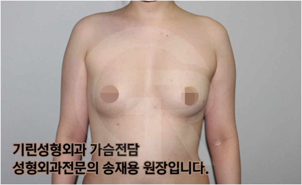 가슴확대수술 후 관리방법, 실제사례 알아보다. [기린성형외과의원_Dr.송재용] 관련 이미지 1
