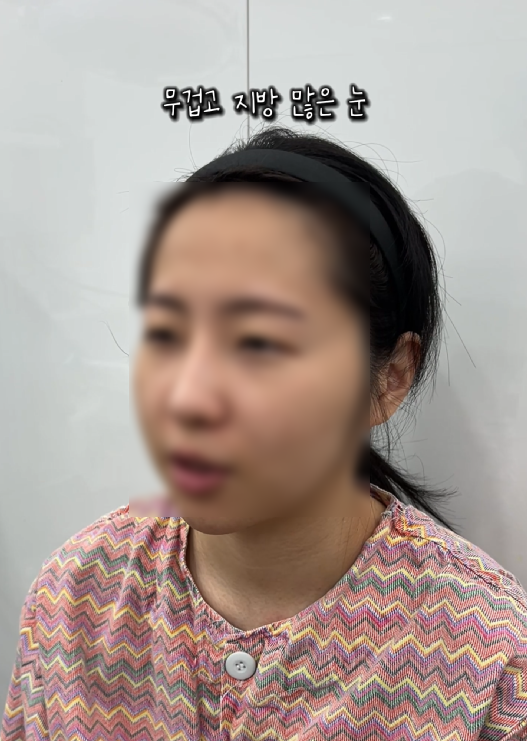 강남역 근처 쌍꺼풀 잘하는 곳 어디? 생생한 후기 관련 이미지 2