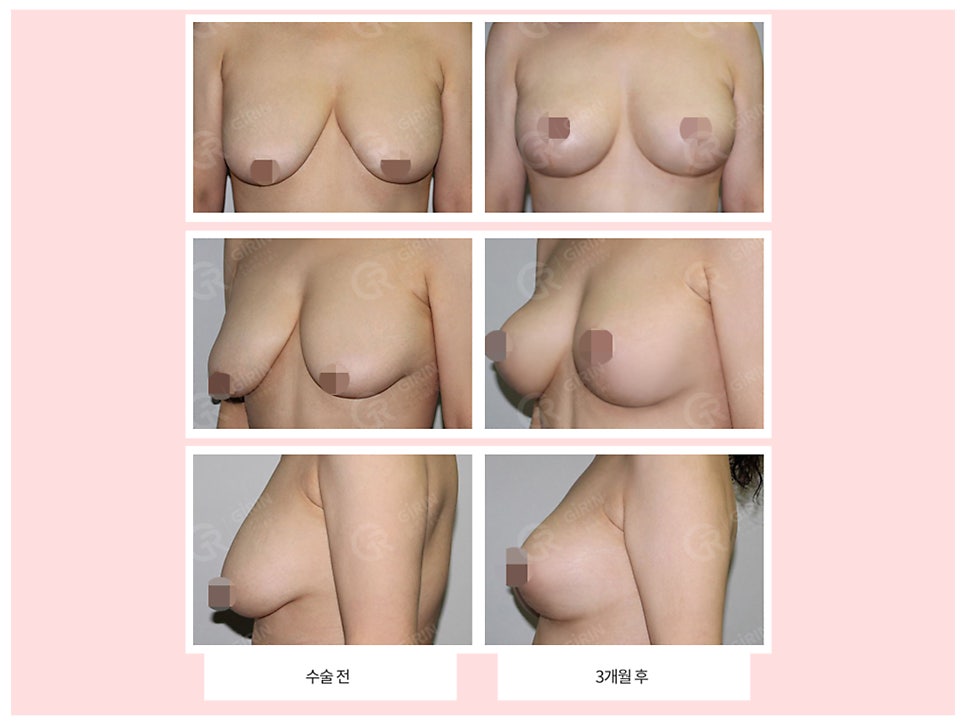 출산후 가슴수술 필요하다 느낀다면 관련 이미지 2