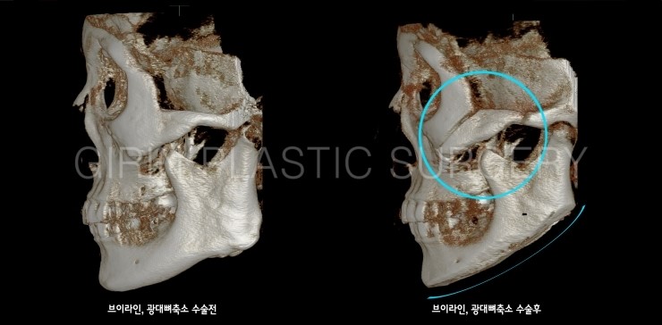 브이라인, 광대고정술 5개월경과 관련 이미지 6