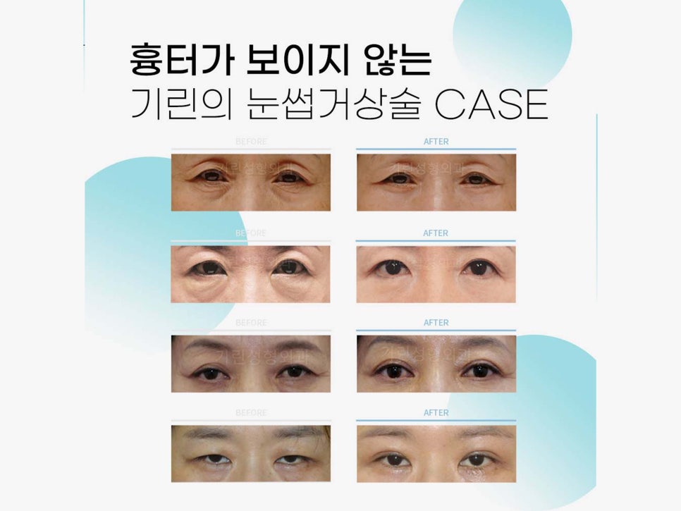 눈썹거상술후기 확인하고 싶다면 관련 이미지 8