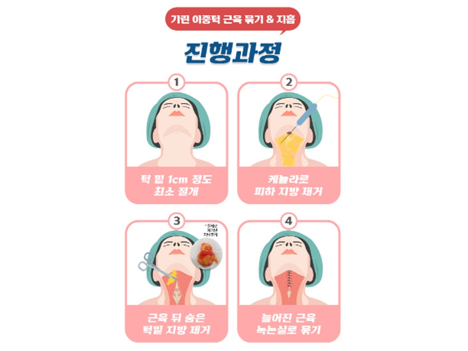 이중턱성형 차이가 궁금하다면 관련 이미지 4