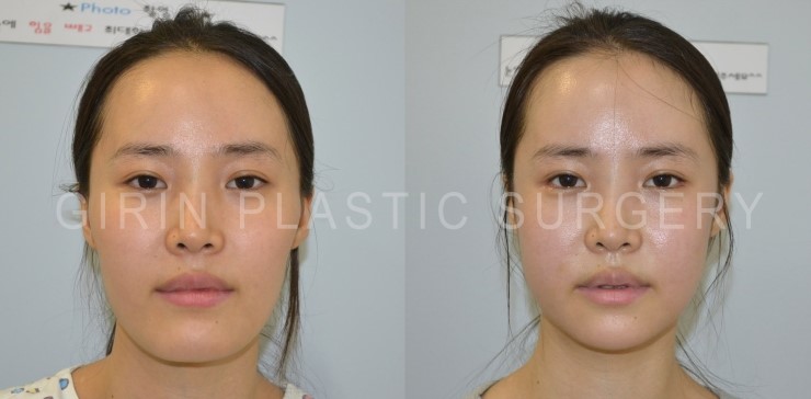 턱길이줄임+브이라인+광대고정술 16일/30일 경과 관련 이미지 1