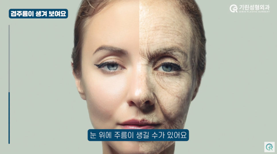 [기린성형외과] "쌍수 망한건가요?"_눈수술 부작용 주의사항 Q&A 관련 이미지 8