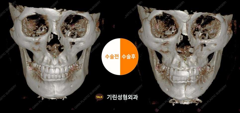 [뉴브이라인] 45도 라운딩 브이라인 절골술로 작은 얼굴 만들기 관련 이미지 12