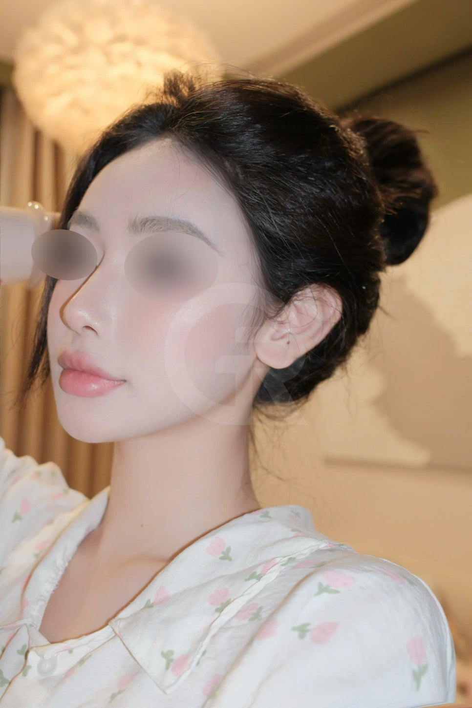 연조직윤곽술, 비대칭을 최소화하는 방법 관련 이미지 8