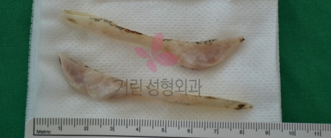 기린성형외과 긴곡선절제술 후 절골된 뼈(bone) 관련 이미지 1