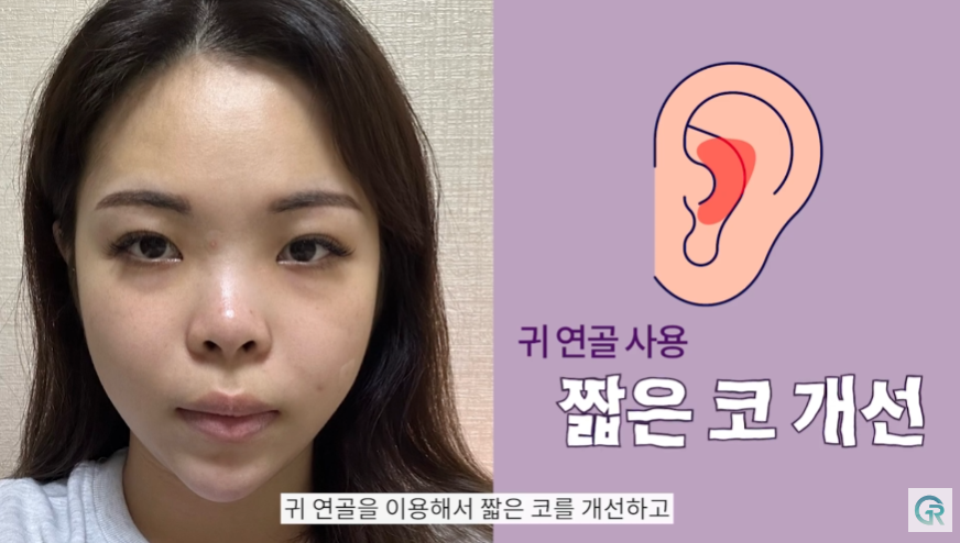 [기린성형외과] 짧고, 들린 코 탈출!_코성형 수술일지 관련 이미지 6