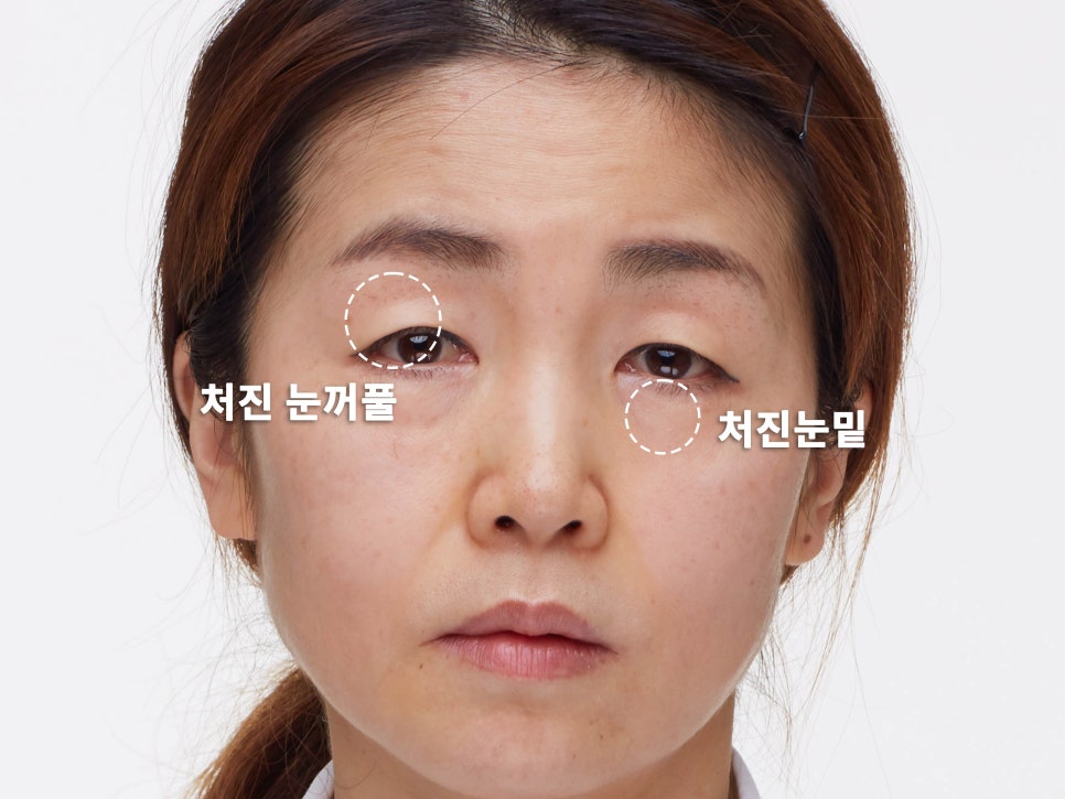 강남눈성형 눈매 개선 만족스럽게 관련 이미지 3