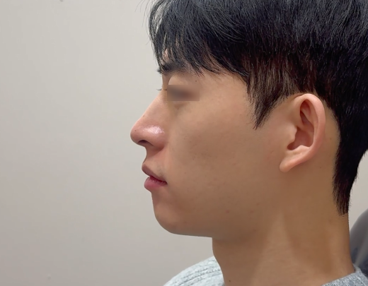 남자 미니젤리코 사례로 보는 코시술 후기 관련 이미지 3