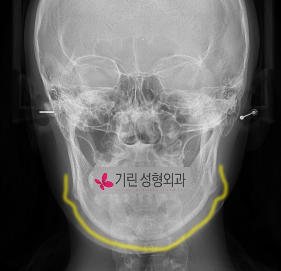 안면형에 맞는 윤곽수술과 효과의 차이 관련 이미지 1