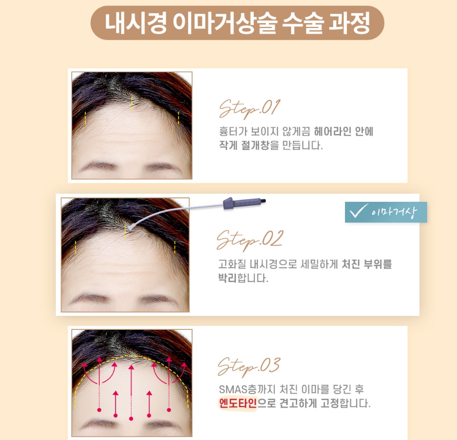 내시경이마거상술 엔도타인 효과 왜 인정받을까? 관련 이미지 3