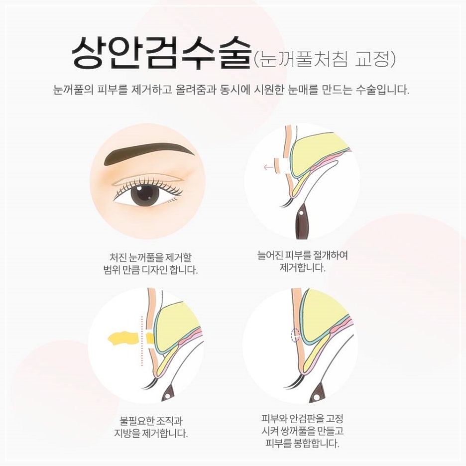 안검하수수술 눈꺼풀처짐 개선이 먼저입니다! 관련 이미지 4